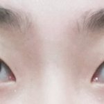 쌍수하면 뭐뭐해야할까?