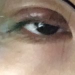 얘들아 쌍수 10일차구 <b>한</b><b>달차</b>였는데 이거 한쪽 <b>눈</b> 웨이러냐