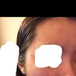 [댓글부탁해] 사진있음) 뒤집어진 피부 회복하기