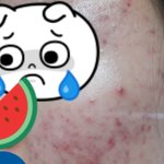 약혐) 이런 여드름 붉은<b>자국</b> 어떻게 해?