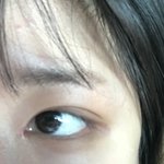 쌍수 <b>절개</b> 한달찬데 너무 얇아