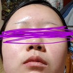 <b>이마</b> 트러블 ㅜㅜ