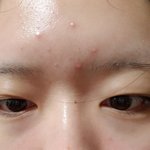 이마 트러블 원인?
