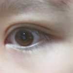 쌍수했는데 이거 <b>지방</b>다시빼야될까?