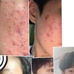 <b>사진</b><b>o</b>여드름 79프로 탈출기 다들 들어와!!