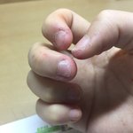 [조언부탁] 약혐 주의) 손톱 뜯는 <b>버릇</b> 어떻게 고쳐 다들???ㅜㅜ