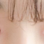 쌍수 붓기 많이<b>심각</b>해?ㅠㅠ