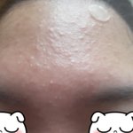 [댓글부탁해] <b>좁쌀</b>여드름이랑 여드름 붉은기ㅜ