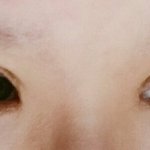 [댓글부탁해] 야 쌍수붓기 이거 정상임...?