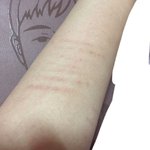 [댓글부탁해] 이거 딱 봤을 때 무슨 <b>흉터</b>같아?