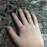 손등에 피나면 <b>소독</b>해야해?