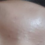 [댓글부탁해] 좁쌀여드름 <b>박멸</b>시킴