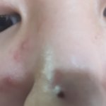 [댓글부탁해] 얘들아 나 피부과 가서 여드름압출받앗는데;