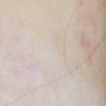 [댓글부탁해] 와 관자놀이 여드름자국 ㅈㄴ 안 옅어짐.. 어떠<b>흑해</b>
