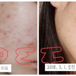 [댓글부탁해] 흉터연고 8일바른 후기