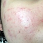 [혐오주의] 나피부 많이좋아지지않앗냐???