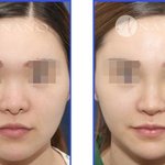 [꼭조언부탁] 과연 <b>콧대</b> 없으면 예쁠 수 있을까??