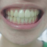 [댓글부탁해] (혐주의;;)나<b>치아</b>많이누런편이야??