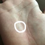 너희 되게 어이없게 다친 일이나 생긴 <b>흉터</b> 있어?