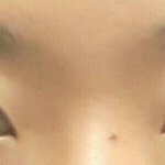 [쌍꺼풀] 성형외과 수술<b>망침</b>