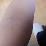 [혐일수도] 나 아토피<b>흉터</b>때문에 스트레스받는데 들어와주라