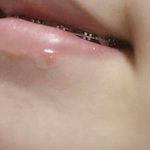 <b>입술밑</b> 여드름 이거머야