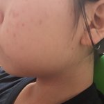 [댓글부탁해] 나 얼굴어떡하지
