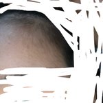 헐 나 <b>이마</b>에 여드름 많이 사라짐 ㅠㅠ