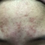 [드루와] 여드름 없애는법좀..혐)