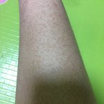 이런걸 뱀살이라고 하는구나!!혐주의