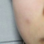 얘들아 이거 여드름이야??