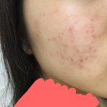 혐주의)) 여드름 많이 <b>심해</b>?