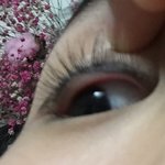 <b>점막</b> 이렇게 채우는거 맞아?