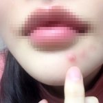 대학병원에서 부작용이 일어났습니다.
