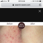 [조언부탁해] 여드름 <b>착색</b> 어찌해?? ㅜㅜㅠ
