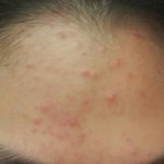 나 이마 여드름 <b>압출</b>했는데