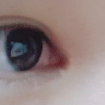 쌍수 + 앞트임 + 눈지방제거 3<b>달차</b>