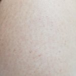 약혐) 다리나 팔에 <b>닭살</b> 심한거 어떻게 해야해ㅠㅠ