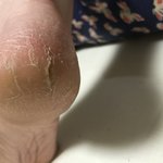 [댓글부탁해] (<b>발사</b>진주의)발 뒷꿈치가 도대체 왜이러는걸까요??