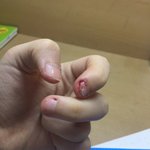 <b>손톱</b> 뜯는거 고치는 법좀 알려주세유ㅠㅠㅠ (혐주의
