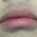 [댓글부탁해] 추가) (약혐) 보온병때매 얼굴 부항떠짐ㅋㅋㅋㅋㅋ...