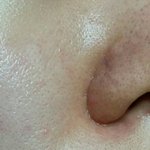 사진-혐오주의 / 심한 블랙<b>헤드</b> 모공..