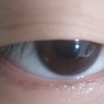 [댓글부탁해] 내 눈 쌍수 잘될 수 있을까? (혐오)