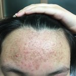 [댓글부탁해] <b>여드름</b> 전문가들 있어?