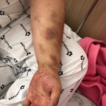 [댓글부탁해] (재업로드)친구의 남자친구가 다쳣습니다