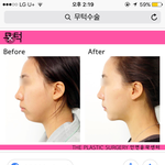 [댓글부탁해] 나 여름방학<b>때</b> 성형하고 싶은데 <b>티</b><b>날</b>것같아??