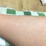 [혐주의] 나처럼 다리 이런 사람 있어? ㅠㅠㅠ