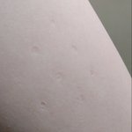 너네도 애기 때 맞은 주사자국 <b>남아</b> 있음??