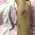 [댓글부탁해] <b>화상</b> 흉질까? 한번만 봐줘ㅠㅠㅠ