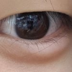 [댓글부탁해] 애<b>교살</b> 필러 맞았다 사진 유
